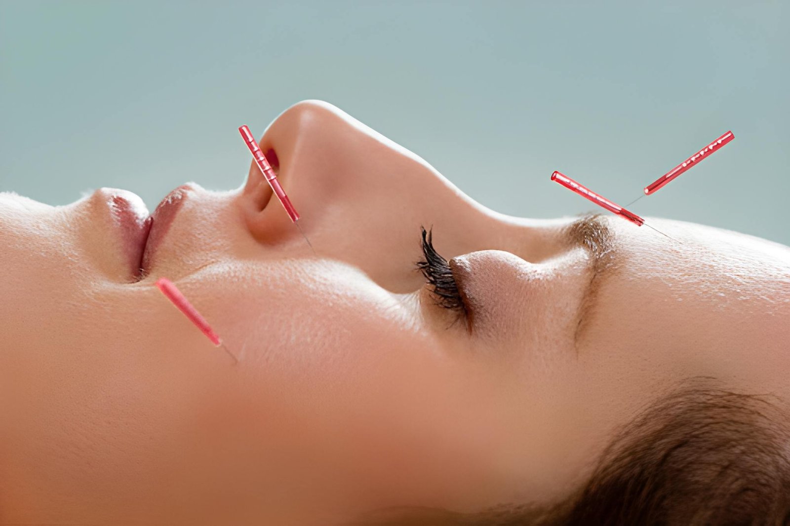 Acupuncture for Acne Vancouver