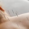 Acupuncture needles placed in the upper back before or after RMT treatment